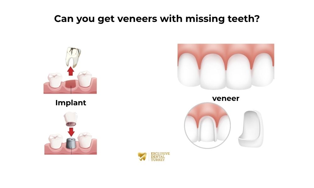 Dental veneers  Turkey Dental veneers Antalya