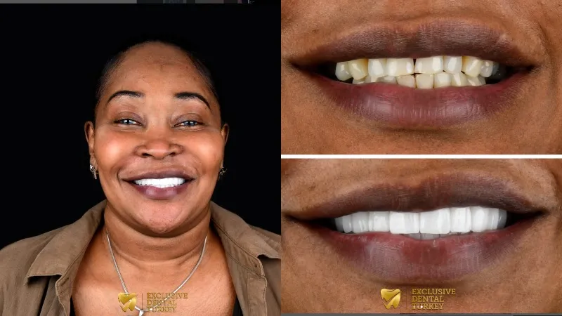 Zirconium crowns before after Turkey Zirconium crowns before after Turkey