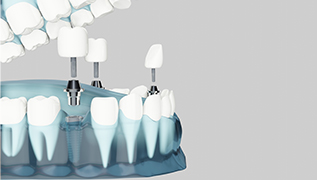 What is the Best Country for Dental Implants ?