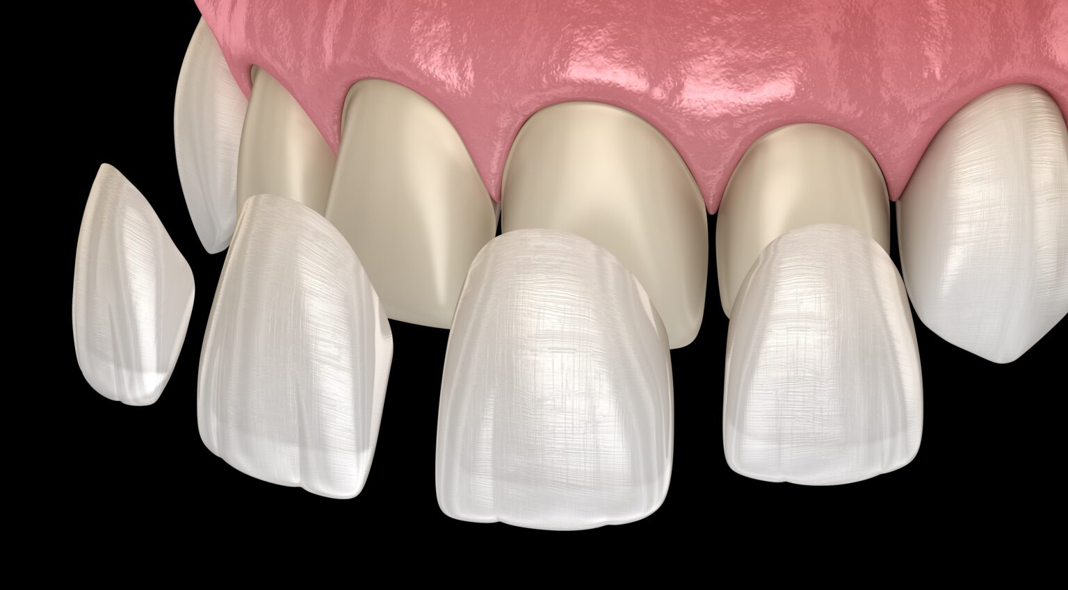 Painless Beauty: The Easy Process of Getting Laminate Veneers